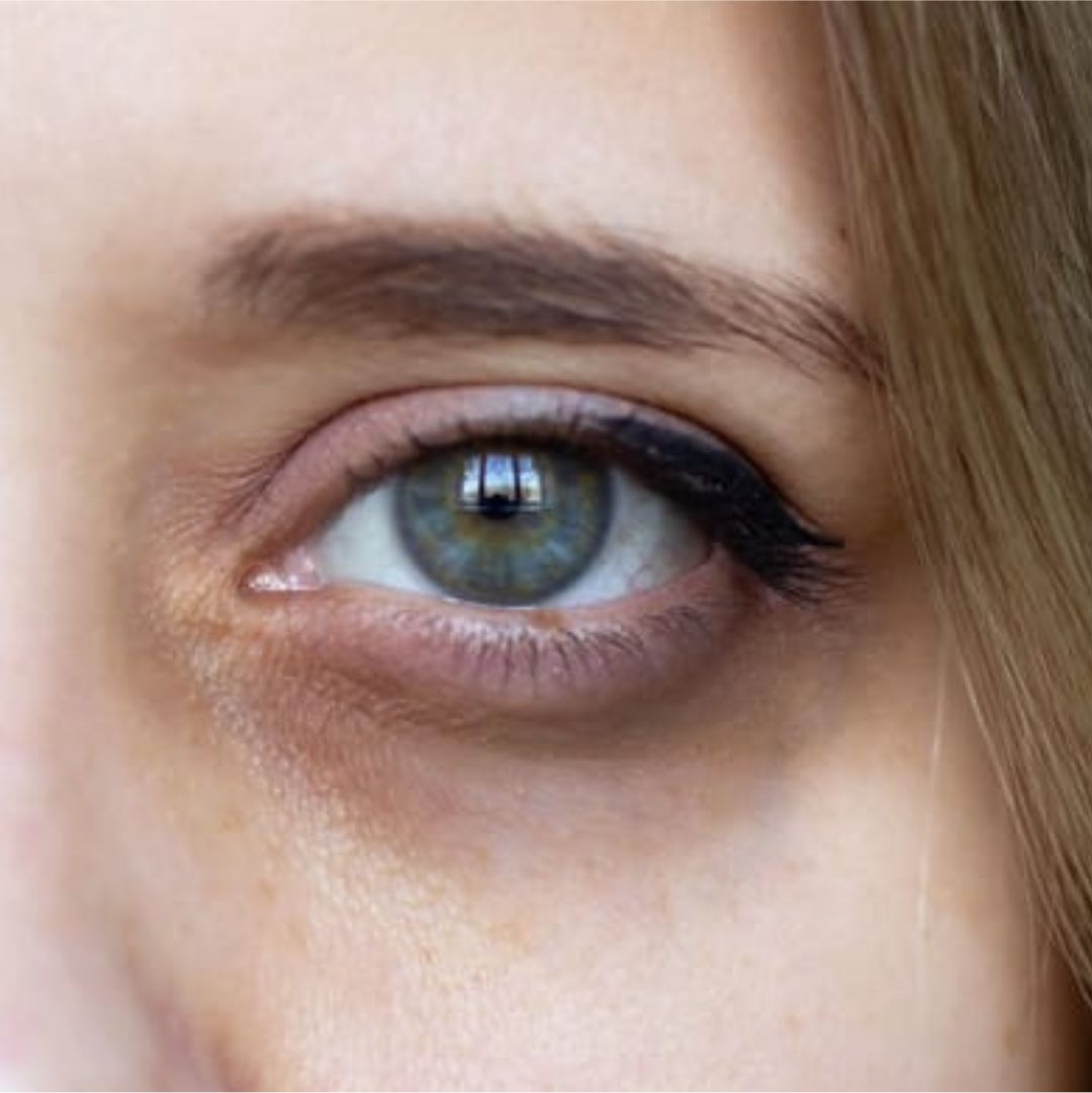 Dark Circles