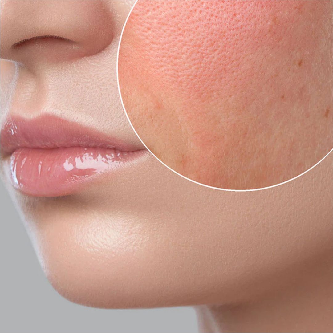 Dry Skin