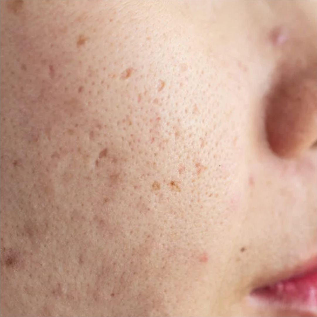 Acne Spots